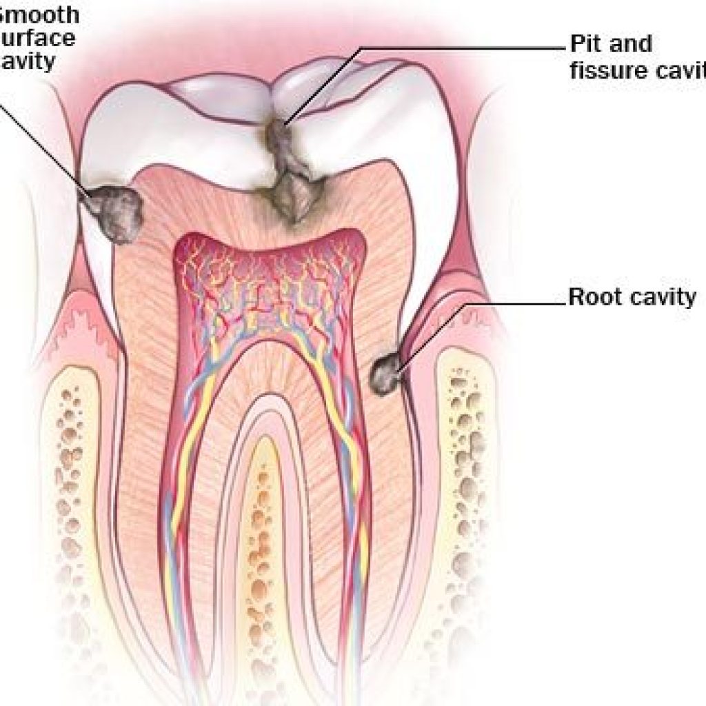 रसुवाका गाउँगाउँमा दाँतको उपचार