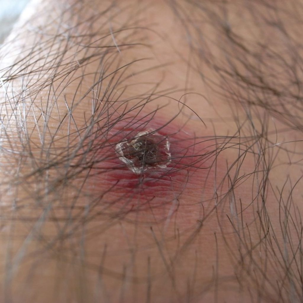 एकसय चारजना ‘स्क्रब टाइफर्स’ सङ्क्रमण