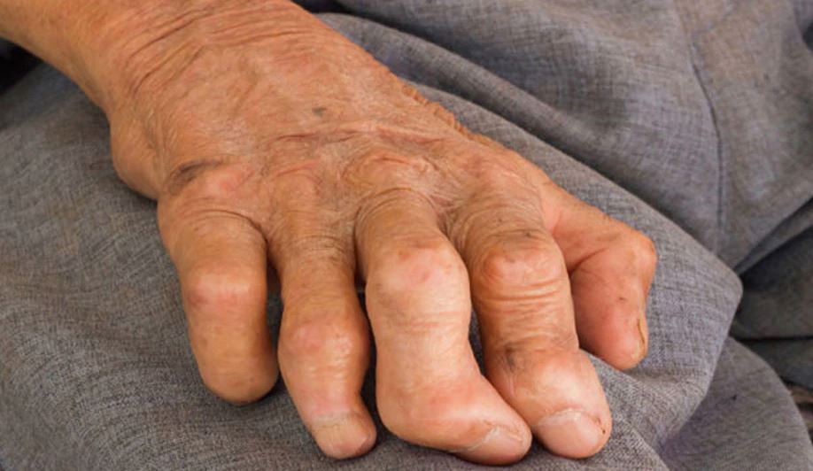 कुष्ठरोगको उच्च जोखिममा बाँके