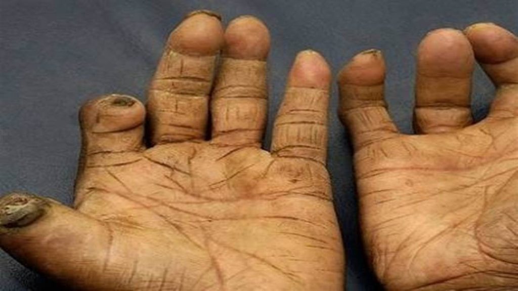 जाजरकोटमा १८ जना कुष्ठरोगी भेटिए : उपचार प्रक्रिया सुरु